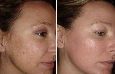 Rexuvenecemento da pel facial láser antes e despois das fotos