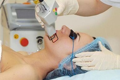 Tipos de rexuvenecemento da pel facial láser